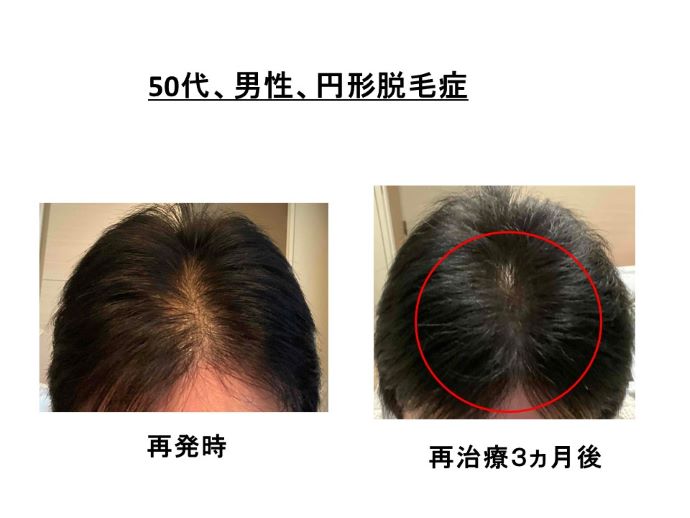 円形脱毛症　病院